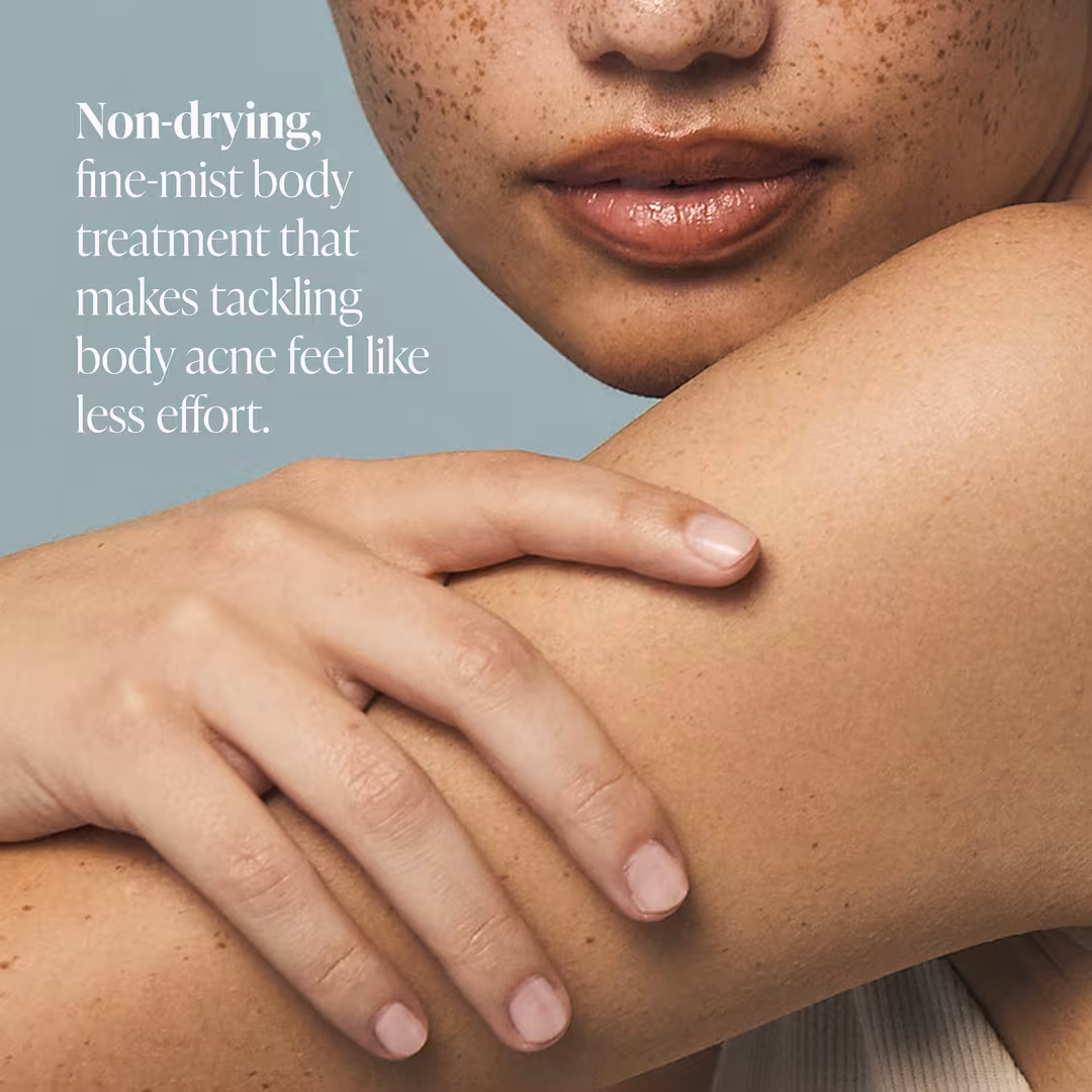 Acne Body Spray Treatment